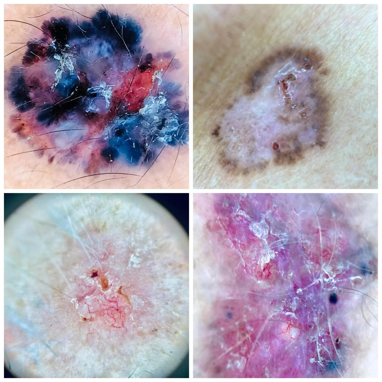 Wideodermatoskopia